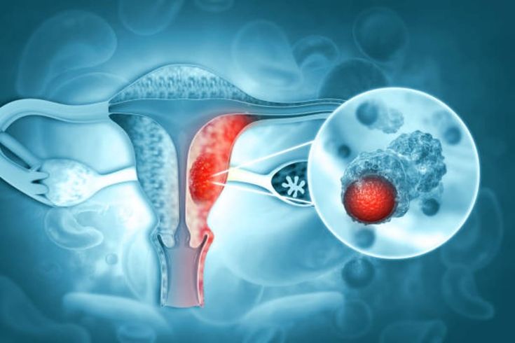 Cervical Cancer Awareness & Prevention