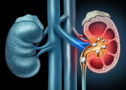 Kidney Stone Symptoms You Should Never Ignore