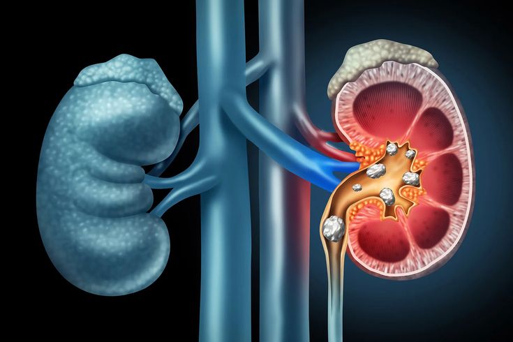 Kidney Stone Symptoms You Should Never Ignore